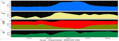 Radiological Correlates of Raised Intracranial Pressure in Children: A Review